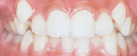 叢生（八重歯） Before