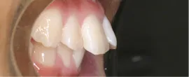 上顎前突（出っ歯） Before