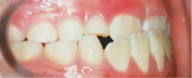 受け口（反対咬合） Before