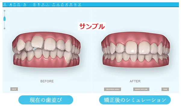 04.【３D画像】歯の動きの立体シミュレーション