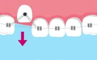 歯に矯正装置を付ける